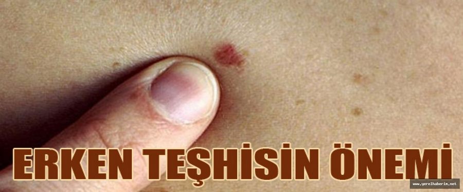 CİLT KANSERİ ARTIK GENÇLERİ DE TEHDİT EDİYOR